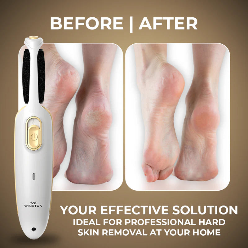 Rechargeable Callus Remover